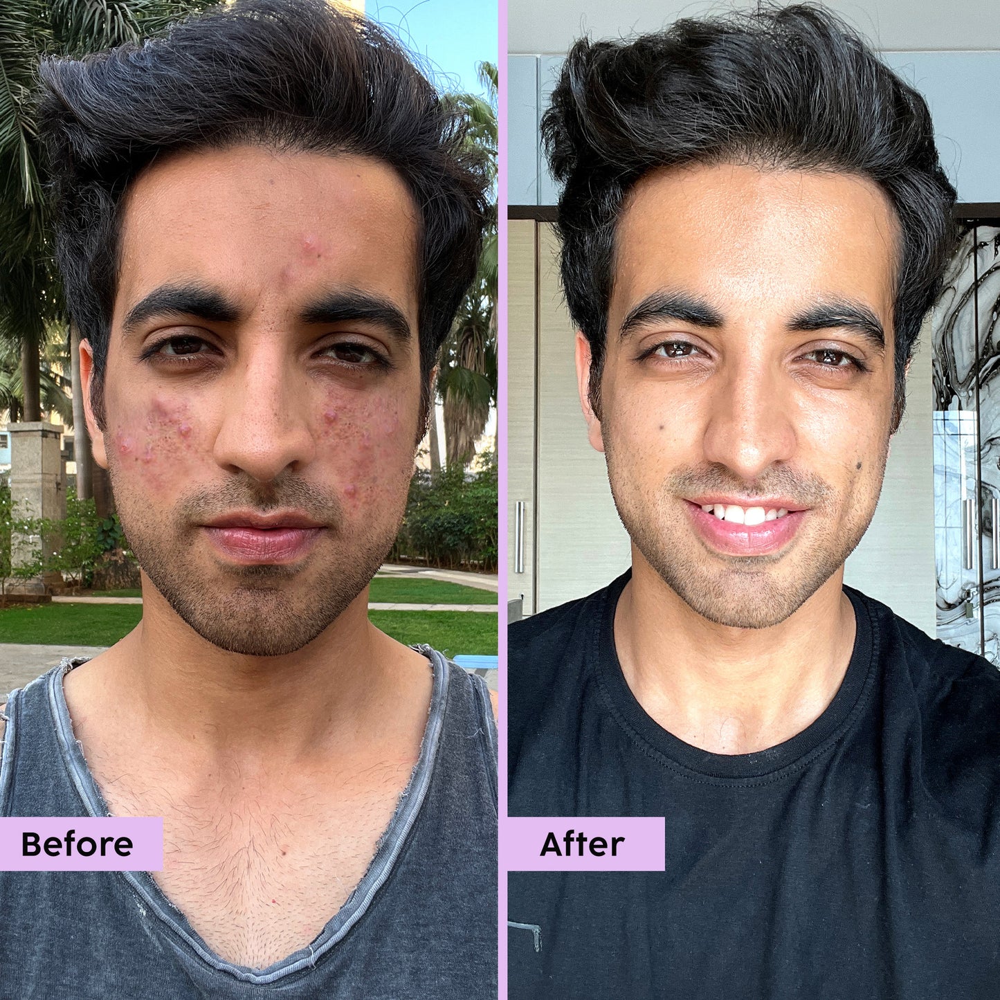 Jamun Active Acne Smoothie Moisturizer with 2% Acne Buster Complex