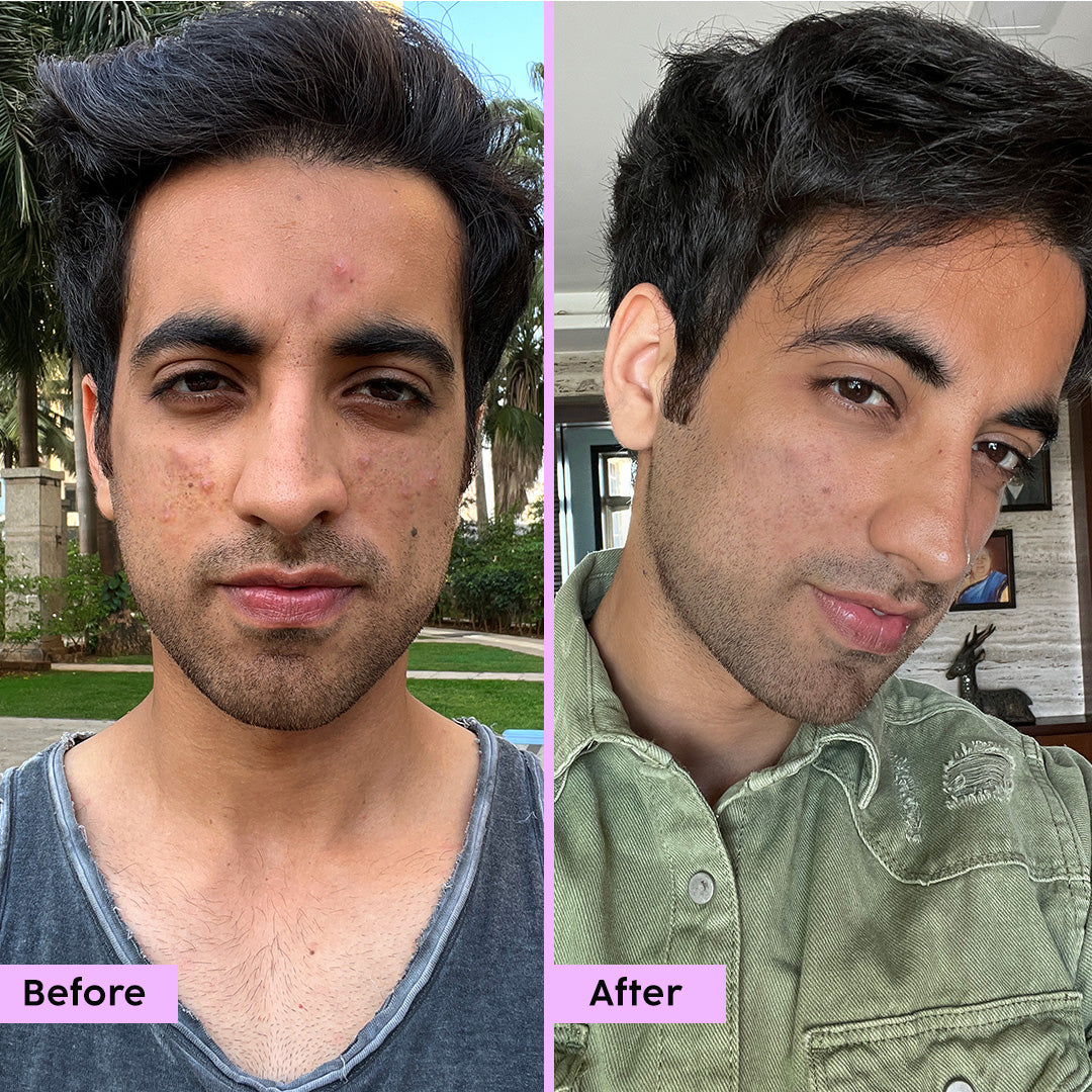 Jamun Active Acne Regime with Cleanser, Serum, Toner & Moisturizer