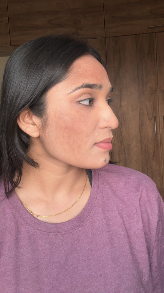 My pigmentation struggle is over - Pranali Mohite