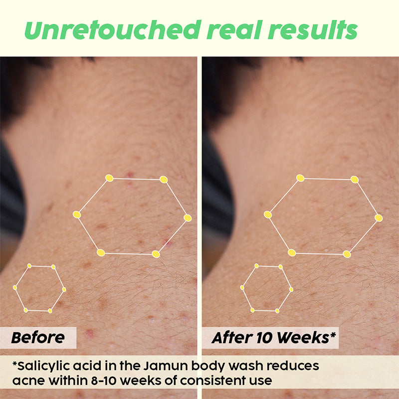 Jamun 2% Salicylic Acid Body Wash For Body Acne, Bumpy Skin