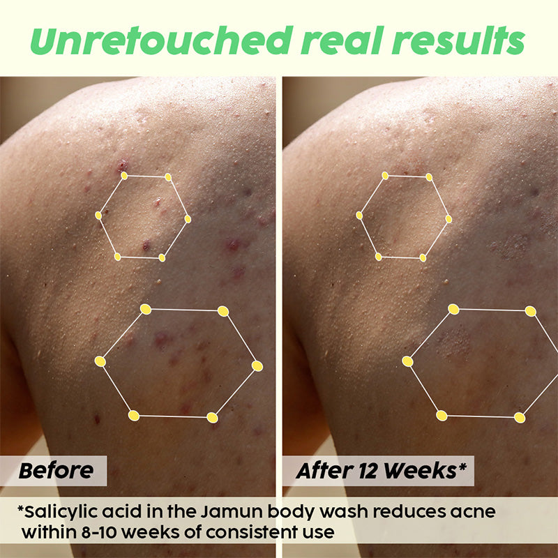 Jamun 2% Salicylic Acid Body Wash For Body Acne, Bumpy Skin