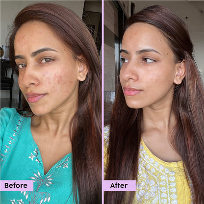 Jamun Acne Marks Regime with Niacinamide & Witch Hazel - Combo