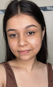 Visible Skin Improvement- Kinjal Shah